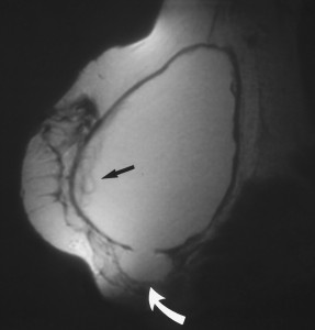 Ruptured-Breast-Implant_Glenn-Vallecillos