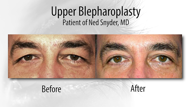 Before and after blepharoplasty.
