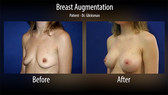 Breast augmentation before and afters.