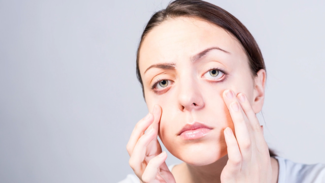 Woman shows the bags under her eyes.