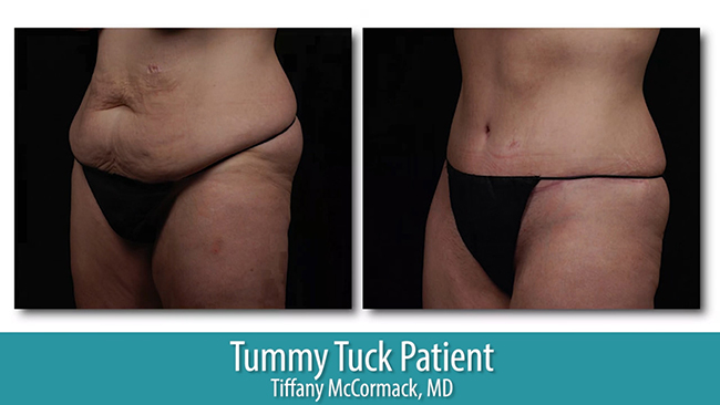 Tummy tuck before and after.