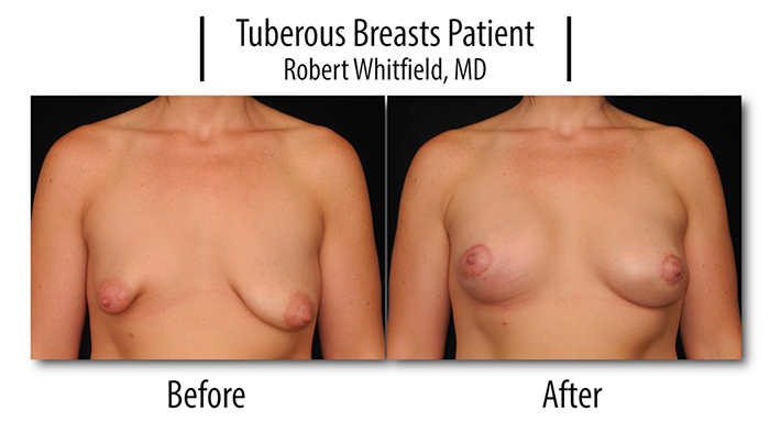 tuberous breasts.00_00_19_14.Still001