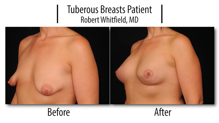 tuberous breasts.00_00_51_22.Still002