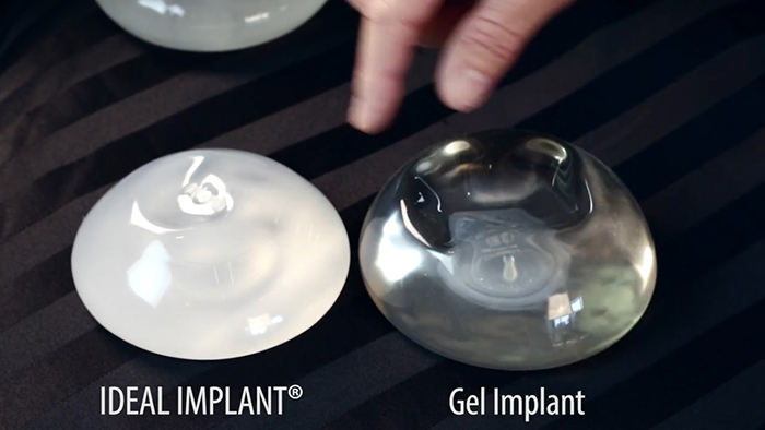 vn - ideal implant.00_00_25_17.Still002