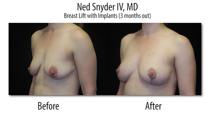 Fat Transfer To Breast