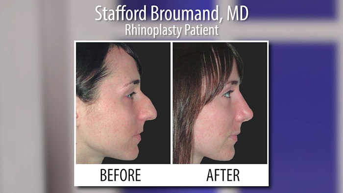 broumand - rhinoplasty.00_00_23_23.Still001