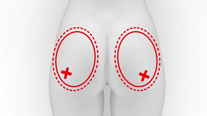 whitfield - gluteal shaping.00_00_15_18.Still001