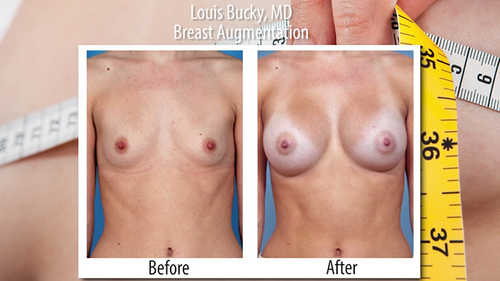 bucky - breast aug advancements.00_00_36_23.Still001