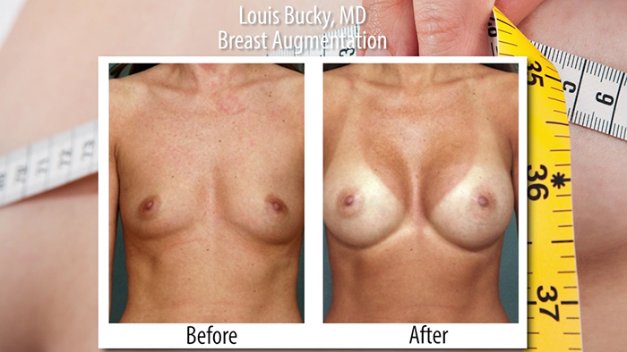 bucky - breast aug advancements.00_01_10_04.Still002
