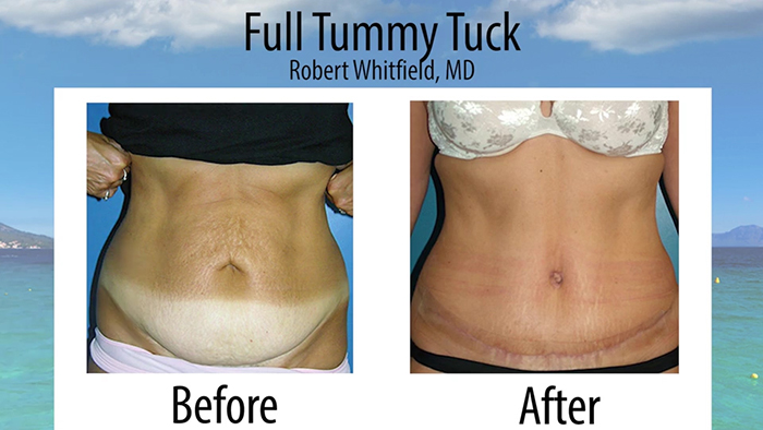 Mini Tuck vs. Full Tummy Tuck! Which is Right For Me? - Macleod