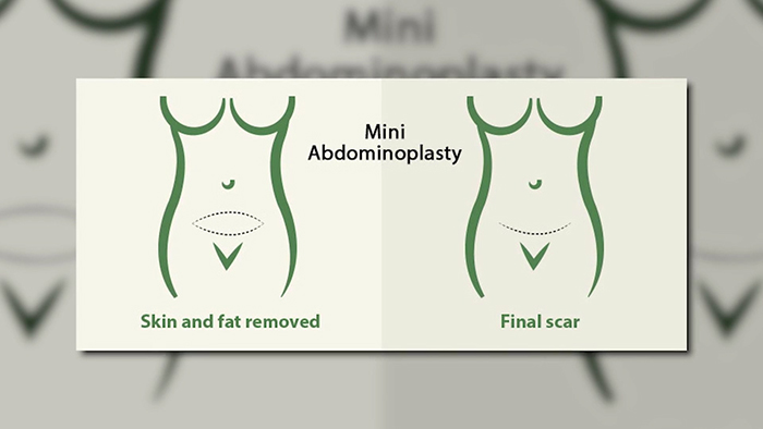 baxter - mini tummy tuck.00_00_21_17.Still001