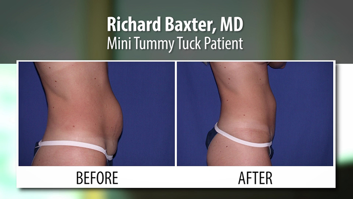 baxter - mini tummy tuck.00_00_27_23.Still003