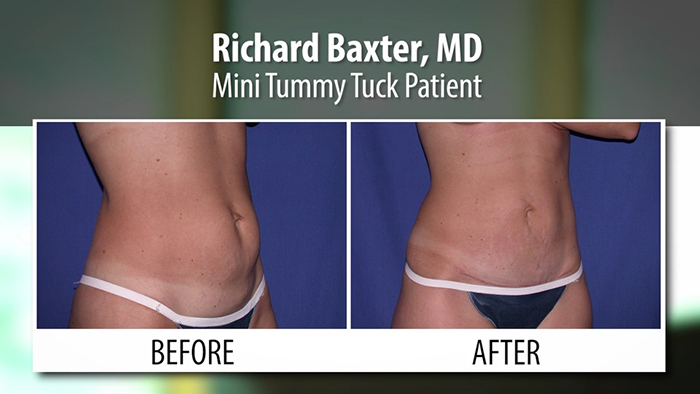 baxter - mini tummy tuck.00_00_30_17.Still002