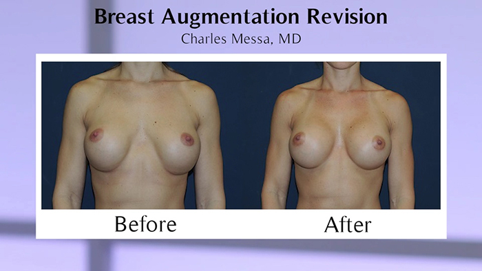 Messa - Breast Aug Revision.00_00_39_02.Still003