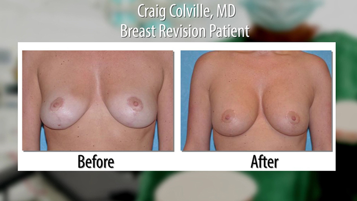 Breast augmentation revision before and after.