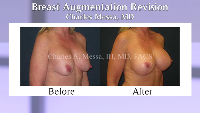 Breast augmentation revision before and after.