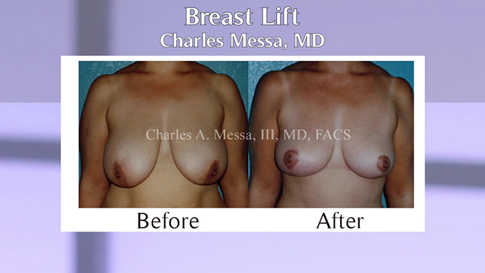 Breast lift before and after.