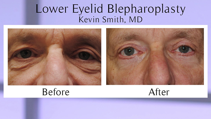 smith-blepharoplasty-00_01_09_19-still004