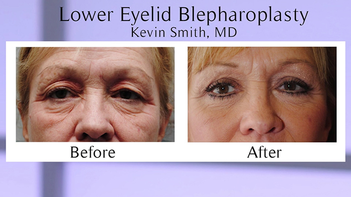 smith-blepharoplasty-00_01_12_04-still003