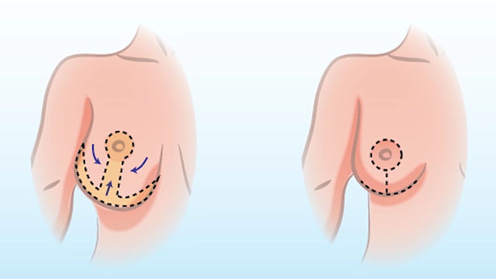 breast reduction diagram