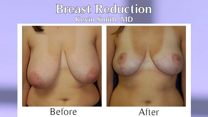 breast reduction before and after