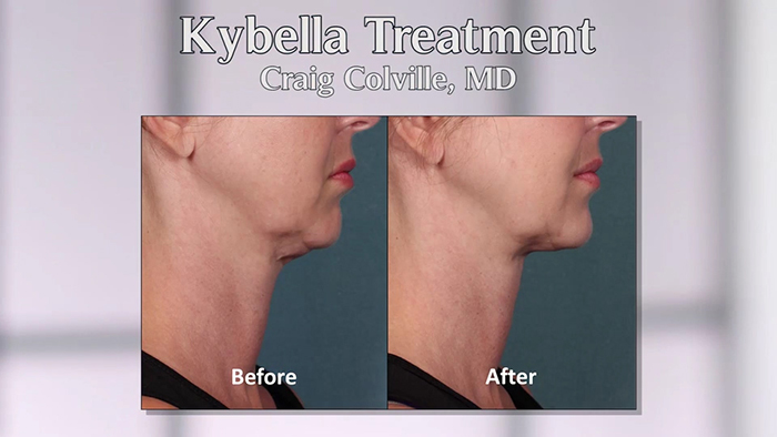 Kybella neck lift before and after.