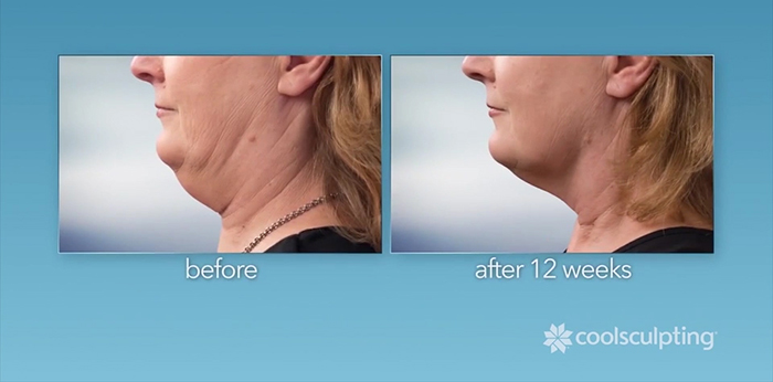 Coolsculpting coolmini neck lift procedure before and after.