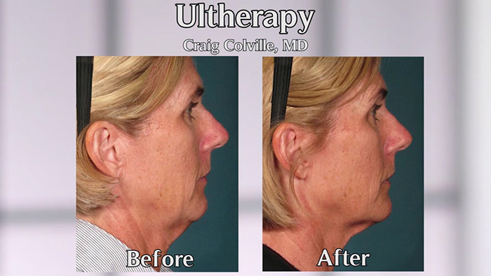 ultherapy before and after