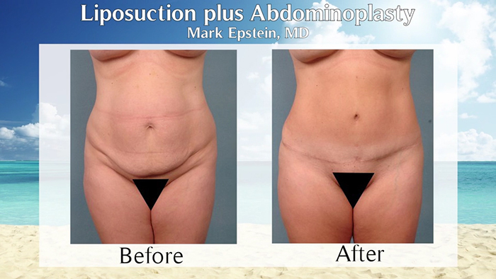 tummy tuck with liposuction before and after