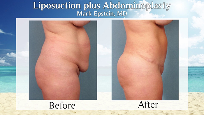 abdominoplasty with liposuction before and after