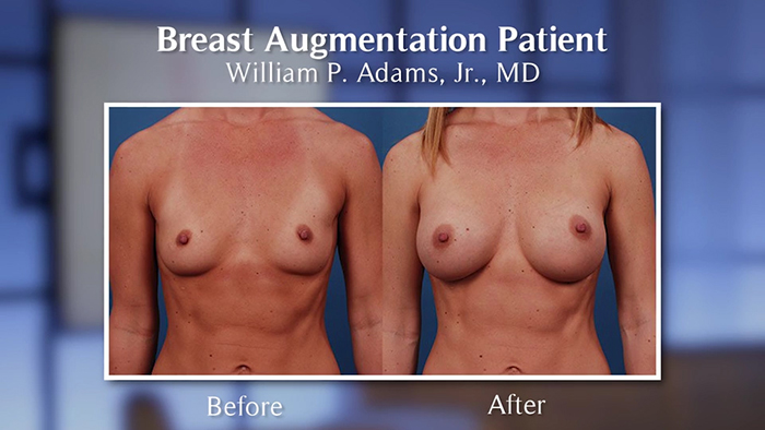 breast augmentation before and after