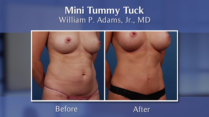 mini tummy tuck before and after