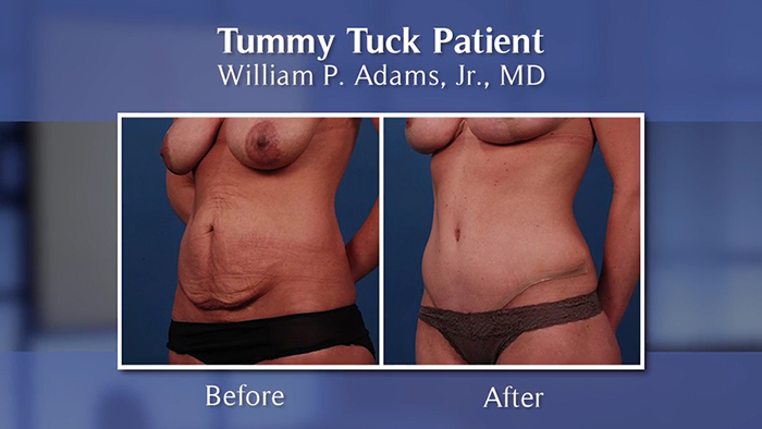 tummy tuck before and after