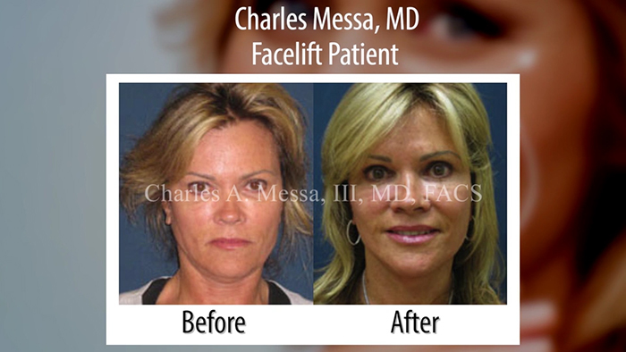 facial rejuvenation before and after