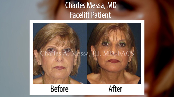 facial rejuvenation before and after