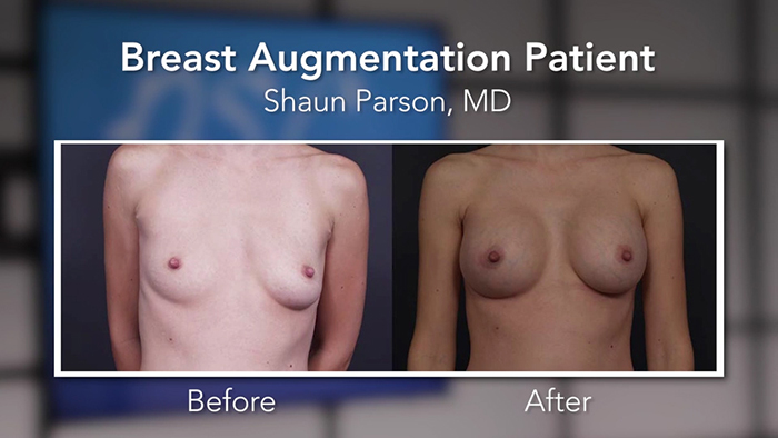 breast augmentation before and after