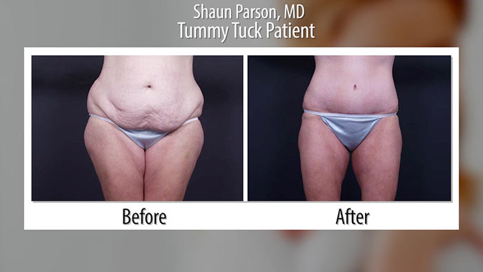 Abdominoplasty procedure before and after.