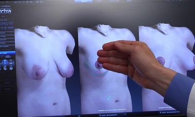 imaging breast augmentation in 3D for proper size selection