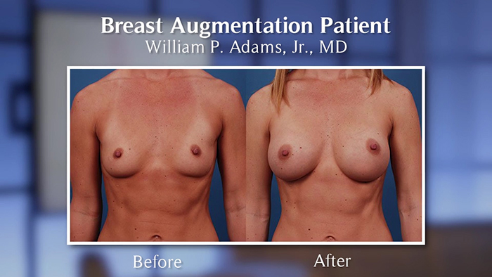 breast augmentation result with proper implant size selection