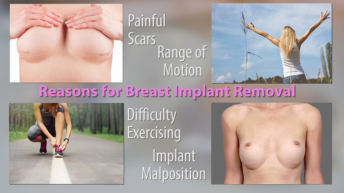 Options for breast implant removal.