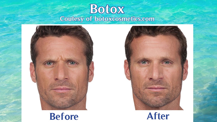 Botox before and after.