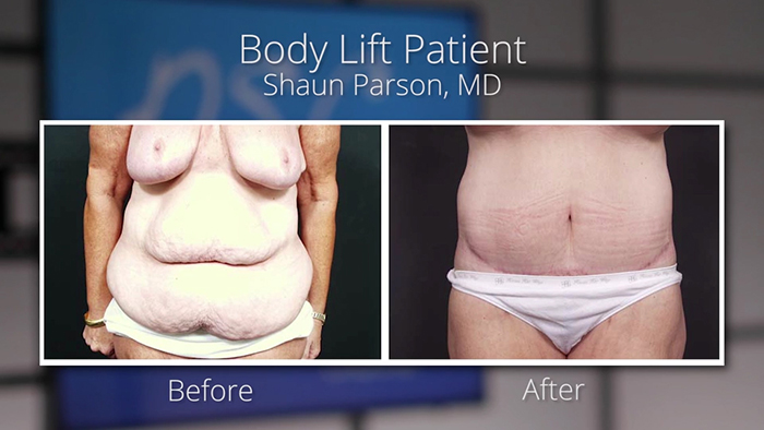 Massive weight loss - body lift patient.