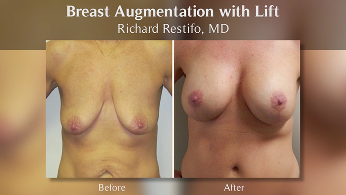 Breast lift with augmentation - Dr. Restifo.