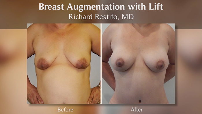 Restifo breast augmentation with lift results.