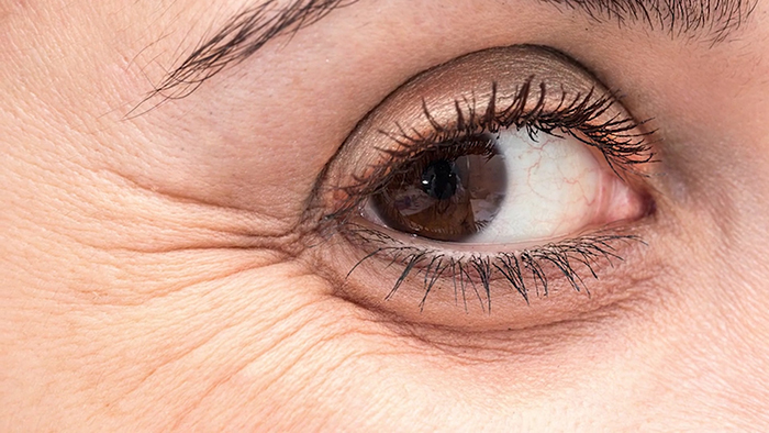 woman with crow's feet and wrinkles