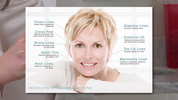 areas where Botox is effective