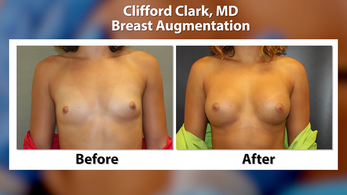 Breast augmentation before and afters.