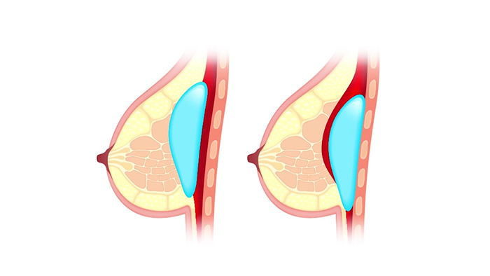 Breast implants above and below the muscle.