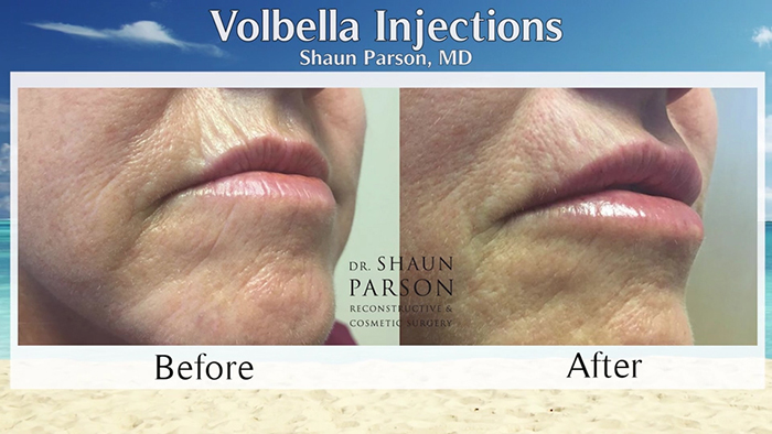 Volbella injection before and afters.