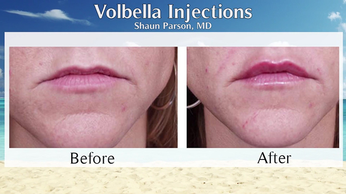 Lip-filling Volbella before and afters.